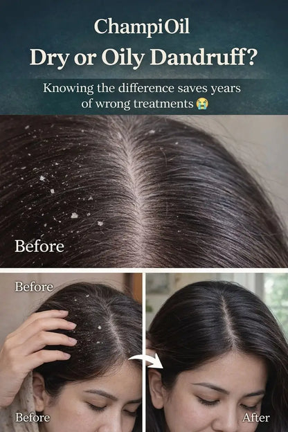 Dry vs oily dandruff comparison showing visible flakes before and clean scalp after