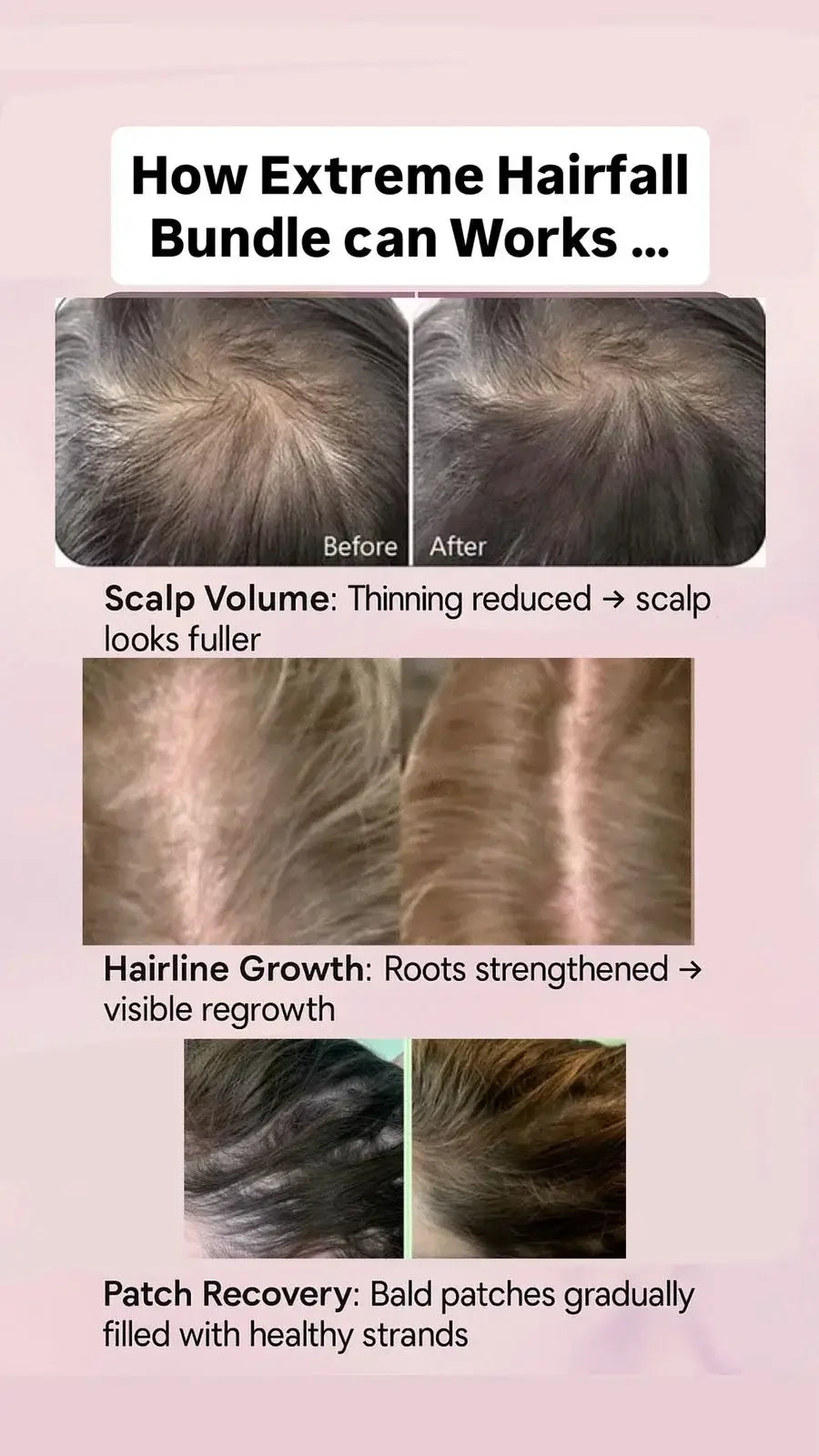 Before and after hair regrowth results for Extreme Hairfall Treatment by Champi Oil.