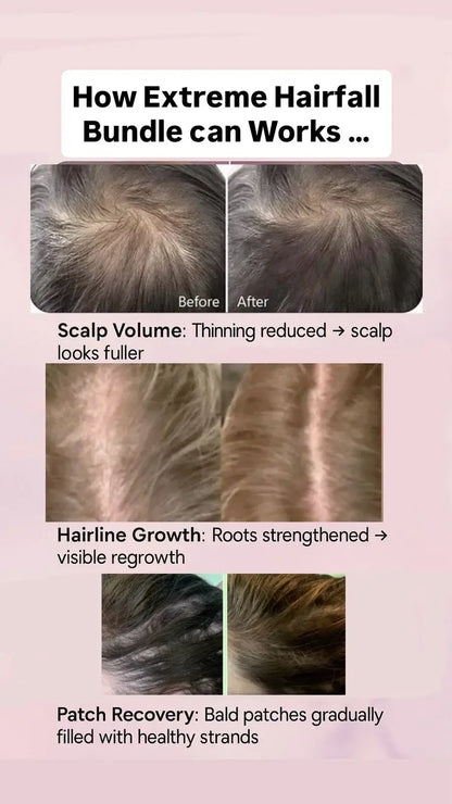 Before and after hair regrowth results for Extreme Hairfall Treatment by Champi Oil.