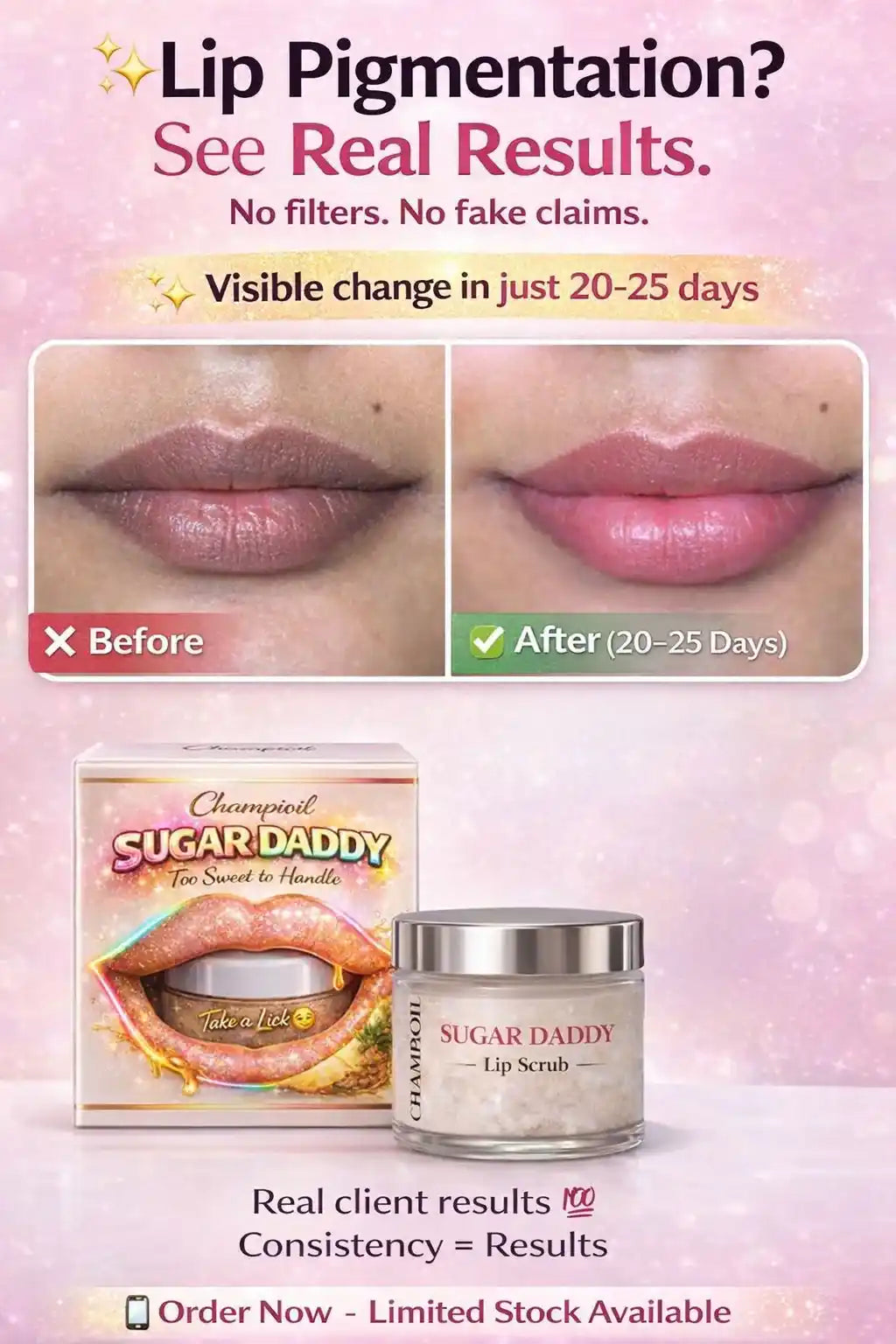 Before and after results of Sugar Daddy Lip Scrub by Champi Oil for lip pigmentation.