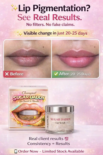 Before and after results of Sugar Daddy Lip Scrub by Champi Oil for lip pigmentation.